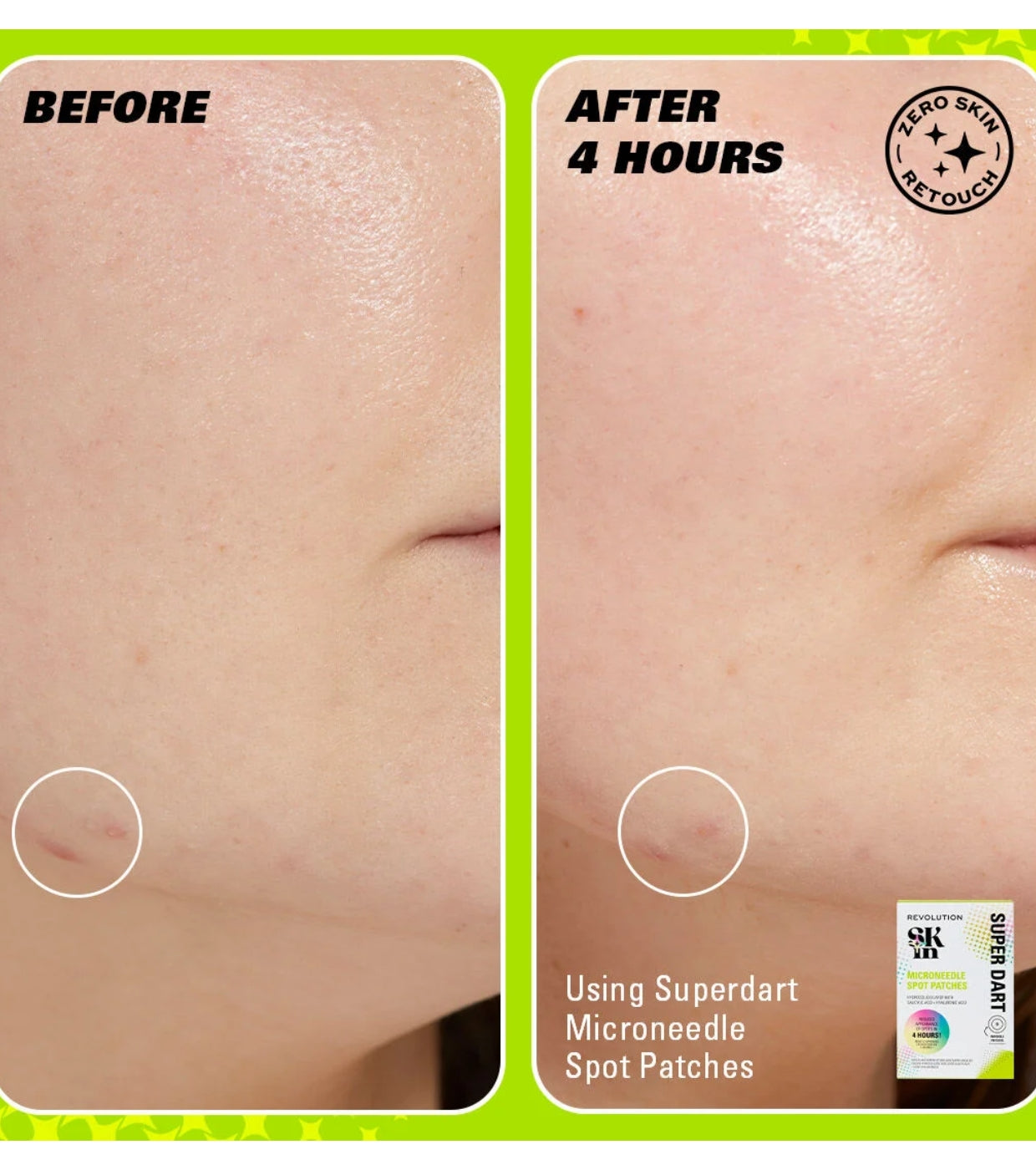 Revolution Skin - Cerotti per brufoli con microaghi Super Dart