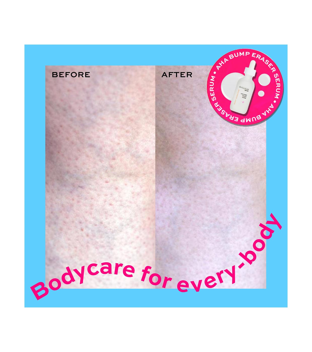 Revolution Skincare - *Body Skincare* - Siero Corpo AHA Bump Eraser